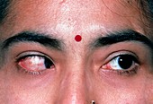 Close-up of woman's eyes showing convergent squint