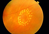 Ophthalmoscope view of laser-treated retinal hole