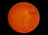 Ophthalmoscopy of retina showing drusen