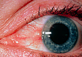 Close-up of eye showing inflamed pinguecula