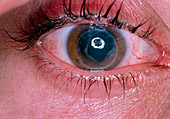 Rejecting corneal graft in man's eye