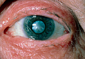 Close-up of cataract in eye
