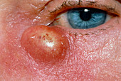 Close-up of lacrimal abscess under eye