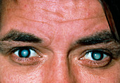 Male patient's eyes with mature cataracts