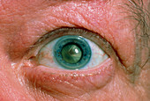 Close-up of patient's eye with trauma cataract