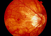 Ophthalmoscopy of cracked retina in myopic eye