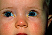 Close-up of baby's eyes with acute conjunctivitis