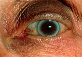 Arcus senilis seen in the eye of an elderly woman