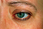 Graves' disease post op: eyelid not retracting