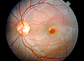 Ophthalmoscopy of retinopathy caused by sunlight