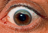 Scarred cornea