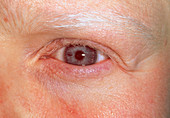 Close-up of the eye of a woman with albinism