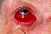 Lowered eyelid of woman with viral conjunctivitis