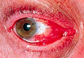 View of an eye after surgery to remove pterygium