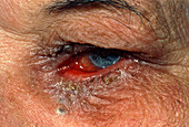 Chronic conjunctivitis caused by ectropion