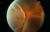 Detached retina