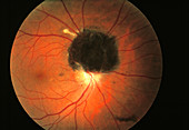 Benign eye tumour