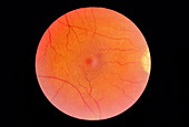 Macular hole on the retina