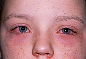 Allergic conjuctivitis