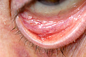 Post-op bruising of the eyelid