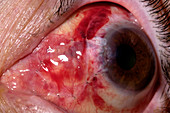 Eye after pterygium excision