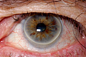 Arcus senilis iris disorder