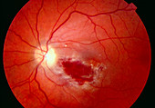 Benign eye tumour