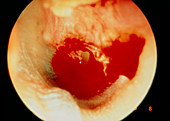 Perforated eardrum due to cotton bud accident