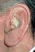 Otitis externa,showing infected outer ear