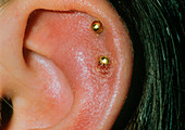 Ear pinna infection due to wearing an earring