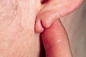 Split pierced earlobe after recurrent infections