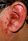 Outer ear infection