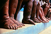 People with filariasis,elephantiasis,of the legs