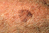 Freckle (ephelis) on skin of 87 year old woman
