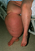 Woman with filariasis (elephantiasis) of the leg