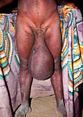 Scrotum enlarged by elephantiasis