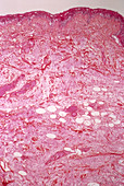 Skin tumour,light micrograph