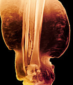 Elephantiasis,MRI scan