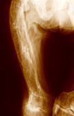 Fibrous dysplasia,X-ray