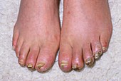Oedema and gangrene affecting a person's toes