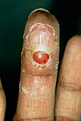 Pyogenic granuloma affecting the finger