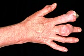 Sufferer of Chronic gout showing hand