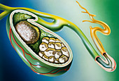 Illustration of stones in the gall bladder