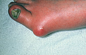 Gout: tophus at the base of the big toe