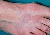 Foot affected by granuloma annulare