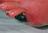 Gangrenous toe caused by ischaemia of the foot