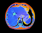 F/colour CT scan of stones in the gall bladder