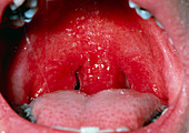 Throat infection: streptococcal pharnygitis