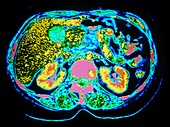 Coloured CT scan of gallstone in liver
