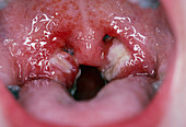 Infected tonsils of patient with glandular fever